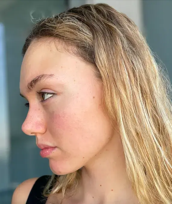 Alda, 28 after treatment