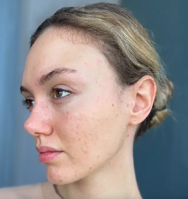 Alda, 28
